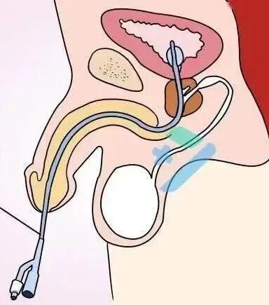 弯头导尿管怎么用导尿的相关问题_https://www.jmylbn.com_新闻资讯_第20张