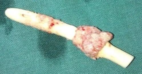 弯头导尿管怎么用导尿的相关问题_https://www.jmylbn.com_新闻资讯_第24张