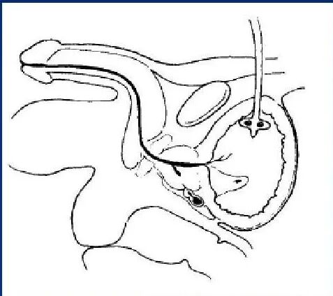 弯头导尿管怎么用导尿的相关问题_https://www.jmylbn.com_新闻资讯_第3张
