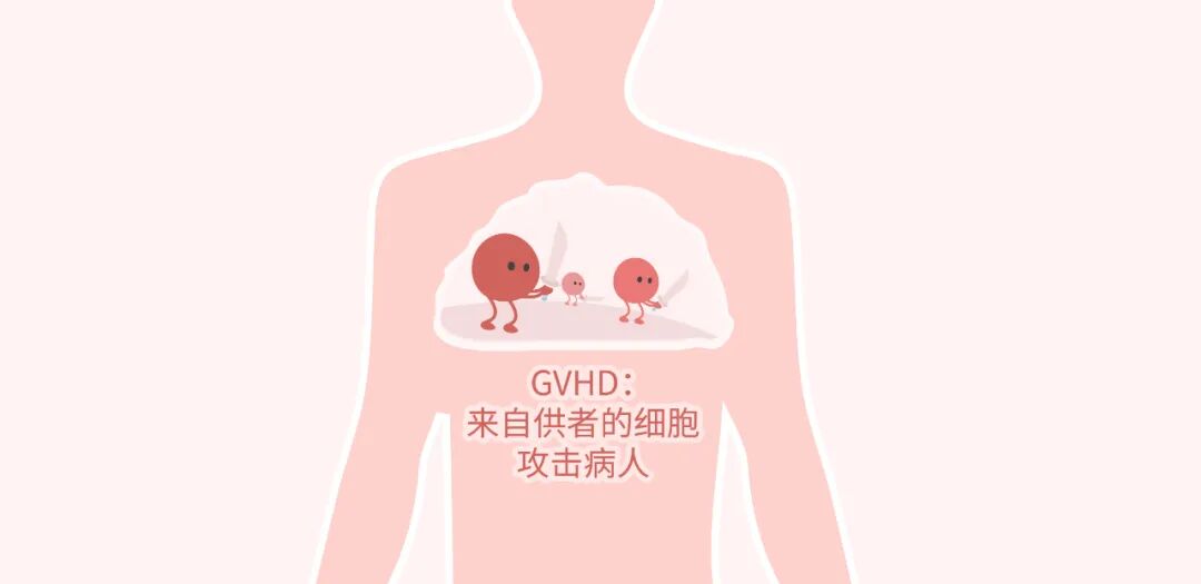 移植的主要并发症,是由于来自异体供者的造血干细胞在病人体内植活后