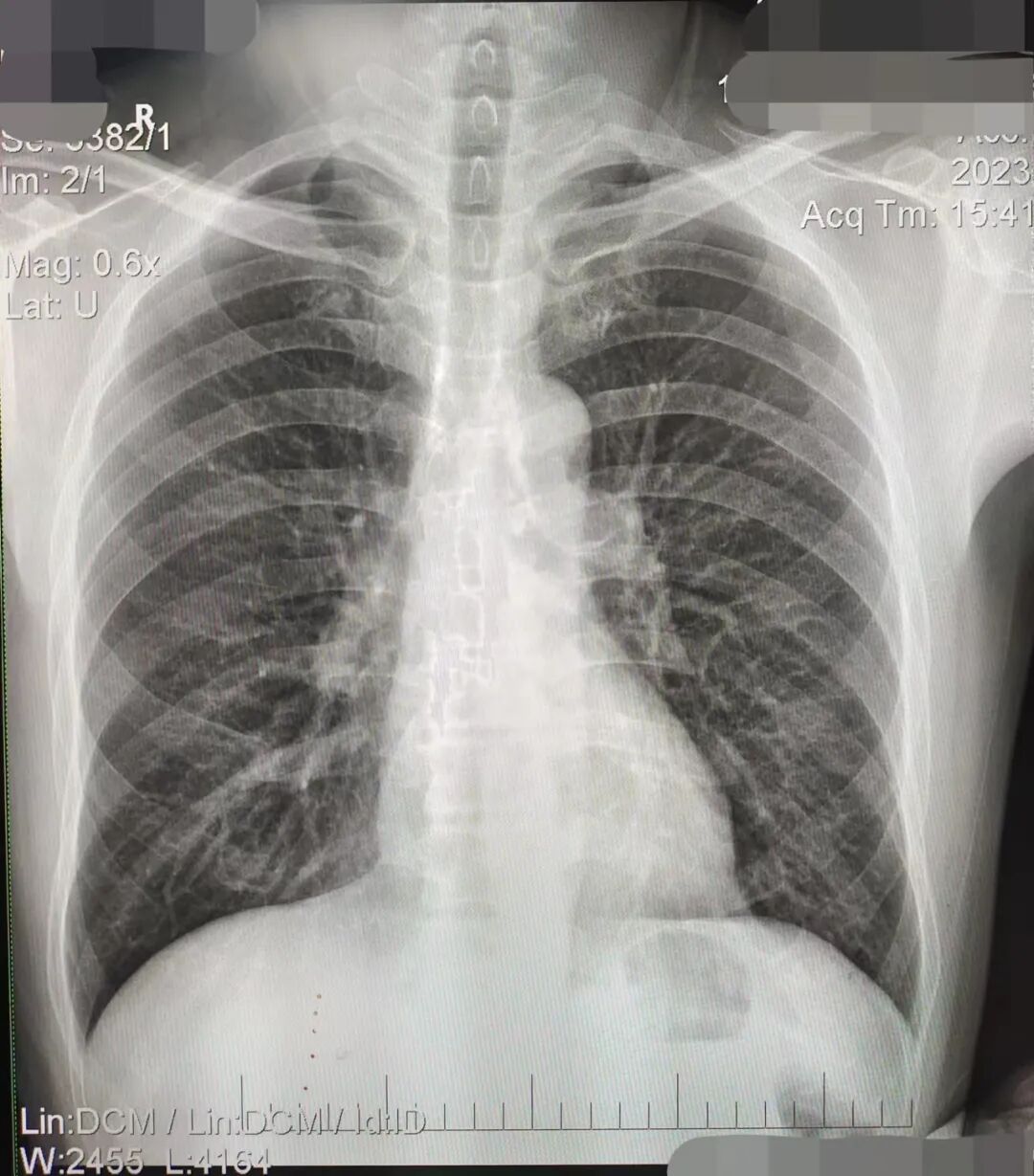 DR胶片为什么分尺寸借DR成像原理详解胸部正位摄片技术参数_https://www.jmylbn.com_新闻资讯_第10张