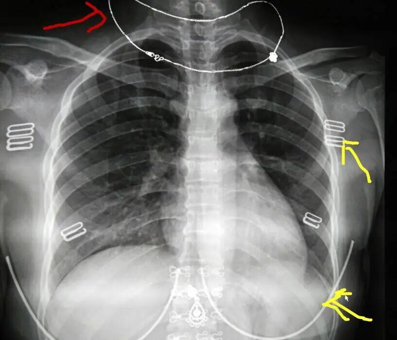 DR胶片为什么分尺寸借DR成像原理详解胸部正位摄片技术参数_https://www.jmylbn.com_新闻资讯_第8张