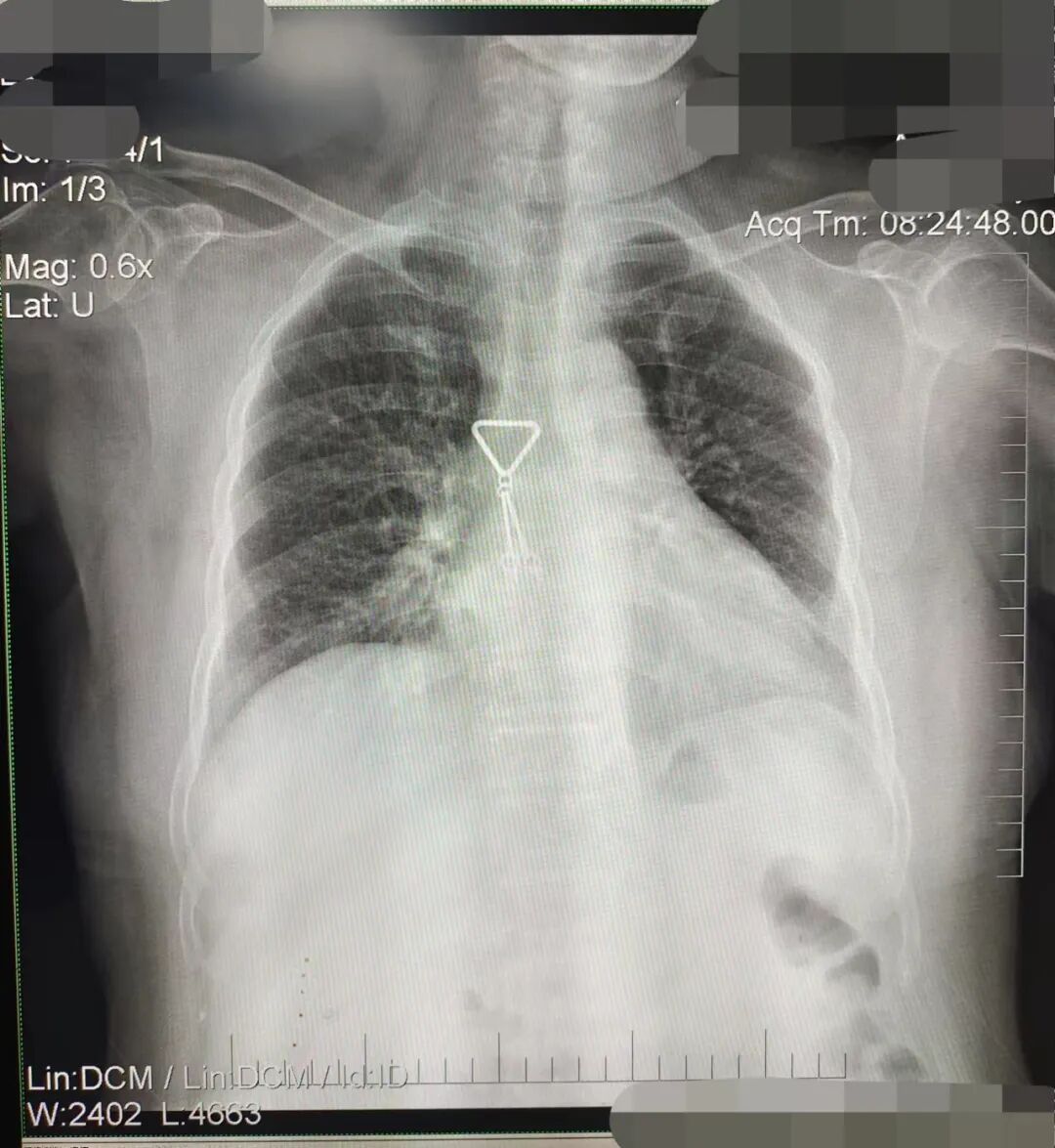 DR胶片为什么分尺寸借DR成像原理详解胸部正位摄片技术参数_https://www.jmylbn.com_新闻资讯_第11张