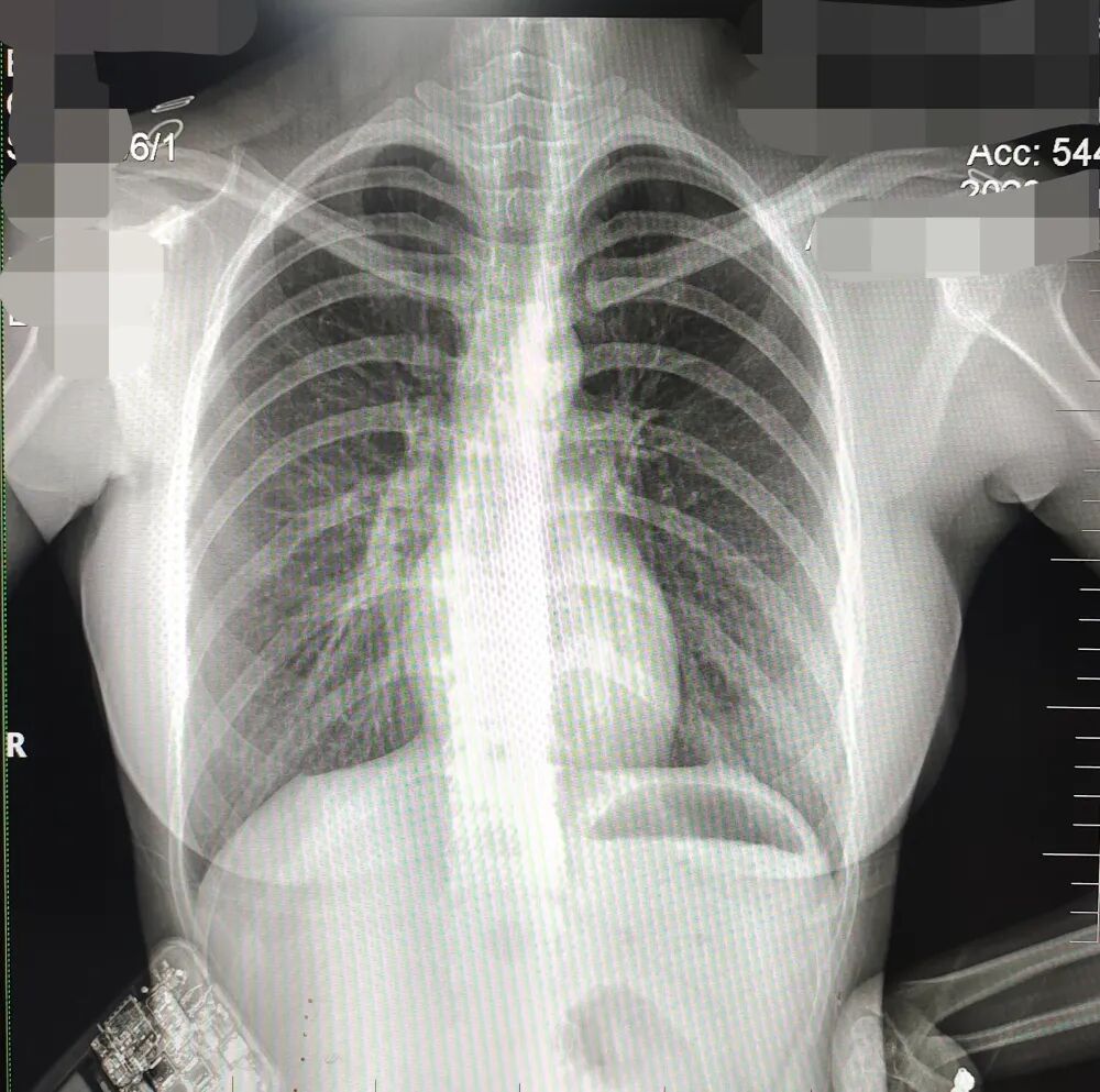 DR胶片为什么分尺寸借DR成像原理详解胸部正位摄片技术参数_https://www.jmylbn.com_新闻资讯_第9张
