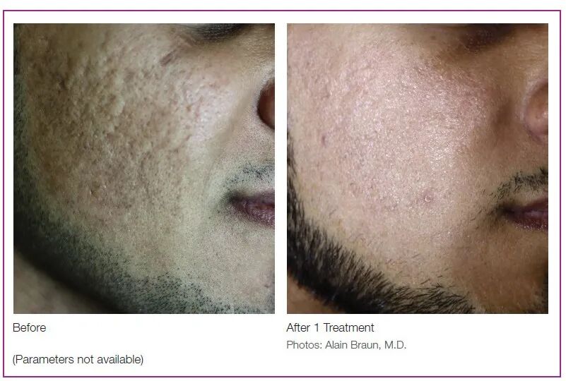 二氧化碳(co2)激光治疗是什么二氧化碳（CO₂）点阵激光，除了治疗痘坑还有哪些功能？_https://www.jmylbn.com_新闻资讯_第10张