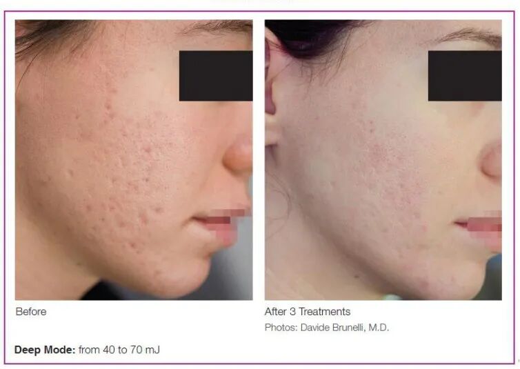 二氧化碳(co2)激光治疗是什么二氧化碳（CO₂）点阵激光，除了治疗痘坑还有哪些功能？_https://www.jmylbn.com_新闻资讯_第11张