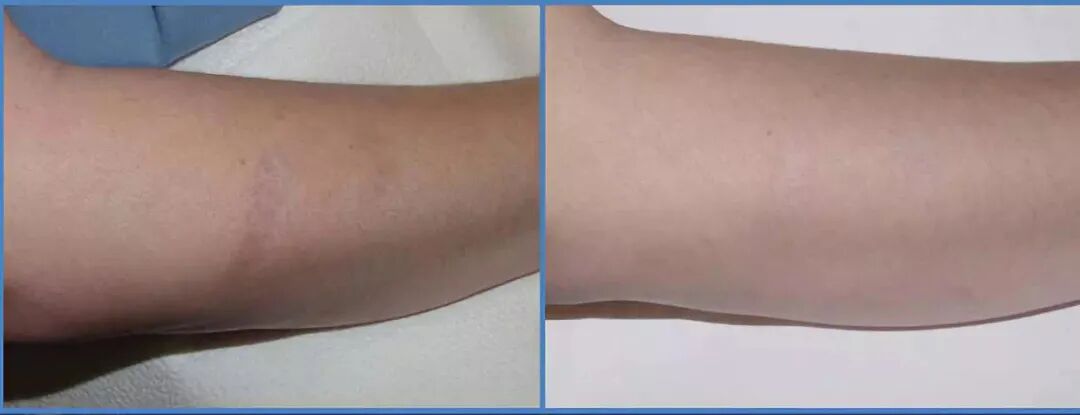 二氧化碳(co2)激光治疗是什么二氧化碳（CO₂）点阵激光，除了治疗痘坑还有哪些功能？_https://www.jmylbn.com_新闻资讯_第12张