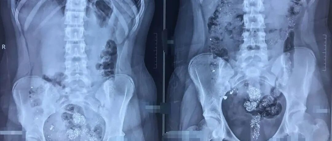 少女打破 17 根体温计，喝下全部水银自杀