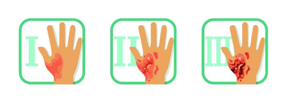 抗菌清创敷料怎么使用烧伤创面如何进行有效清创_https://www.jmylbn.com_新闻资讯_第3张