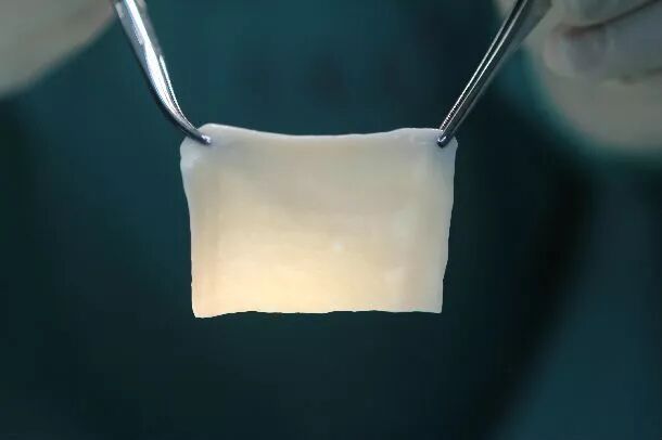 疝气补片怎么固定外科手术中用的疝补片，你了解多少？_https://www.jmylbn.com_新闻资讯_第5张