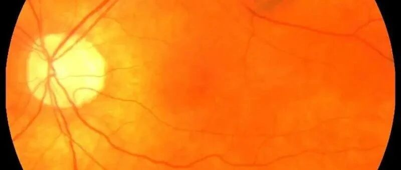 看眼睛就知道患心脏病的风险？ | 微健康