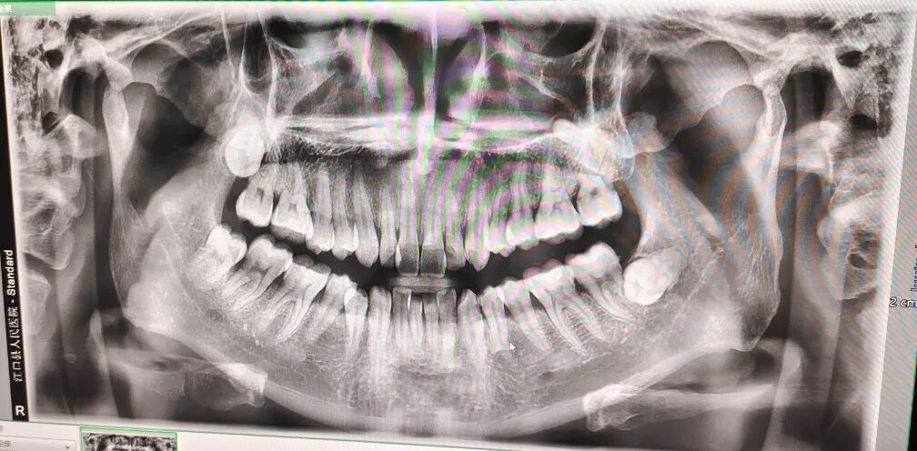 口腔ct怎么拍摄【新设备】牙齿也可以拍CT了！江口县人民医院引进进口高端口腔CT并正式投入使用_https://www.jmylbn.com_新闻资讯_第8张