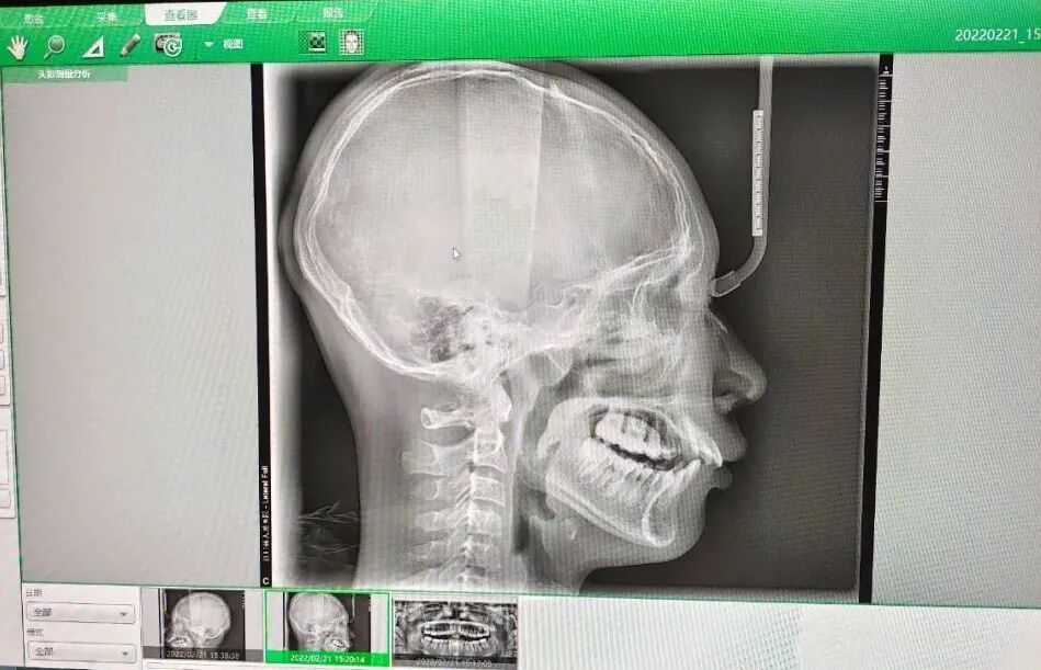 口腔ct怎么拍摄【新设备】牙齿也可以拍CT了！江口县人民医院引进进口高端口腔CT并正式投入使用_https://www.jmylbn.com_新闻资讯_第11张