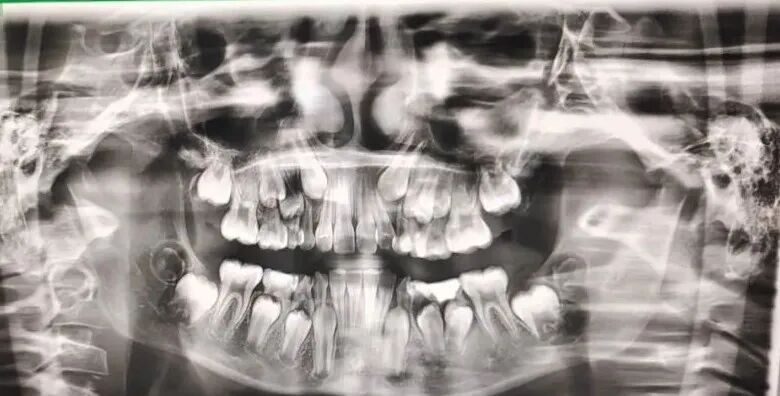 口腔ct怎么拍摄【新设备】牙齿也可以拍CT了！江口县人民医院引进进口高端口腔CT并正式投入使用_https://www.jmylbn.com_新闻资讯_第9张