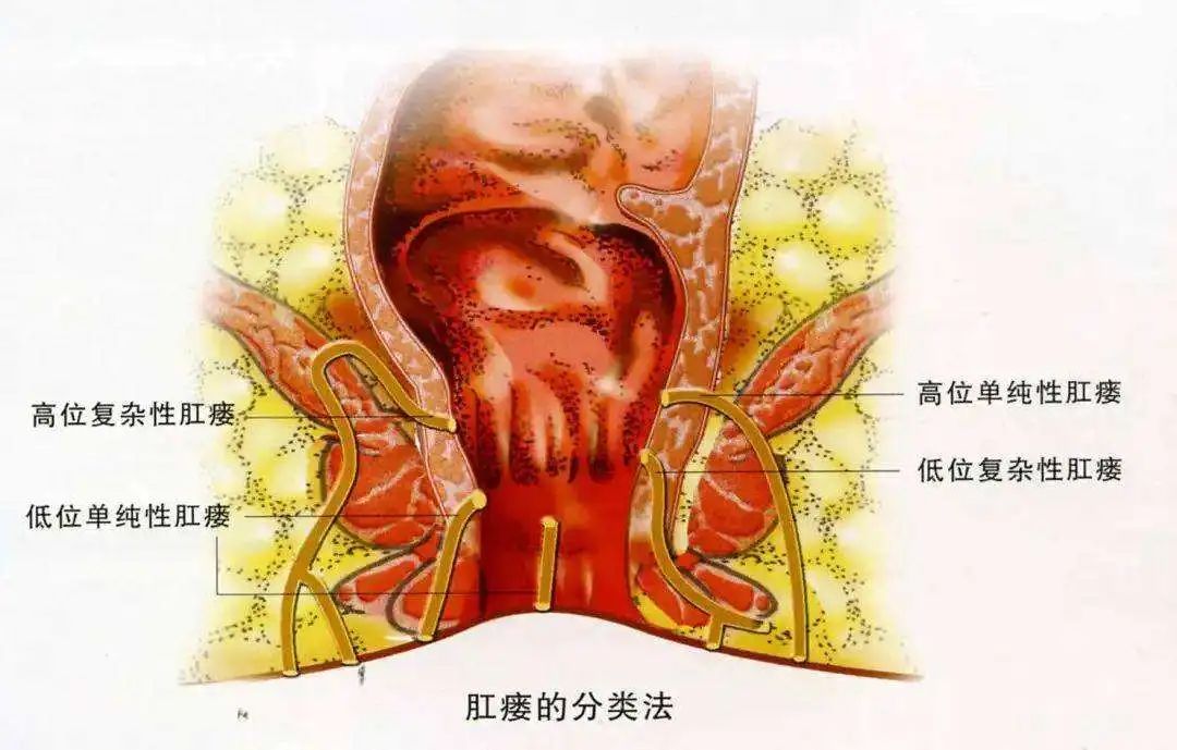 肛周脓肿 男性图片