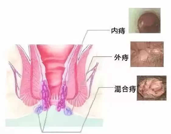 混合痔反复发作让人心忧- 安海阳光医院 微信公众号文章阅读- WeMP