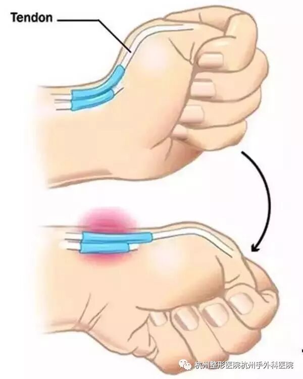 5秒自我测试：你是不是也得了“手机手”？