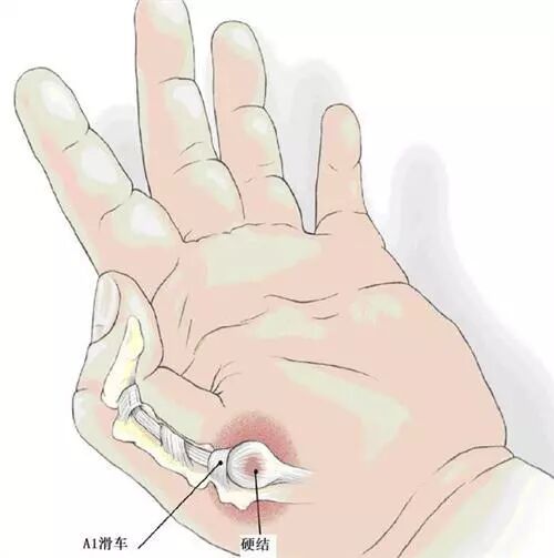 孩子手指伸不直，关节还会发出"噼啪"的响声，要引发重视