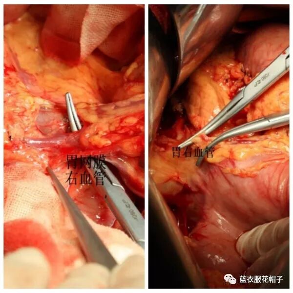 卵圆钳怎么持胸外科手术器械大汇总_https://www.jmylbn.com_新闻资讯_第13张