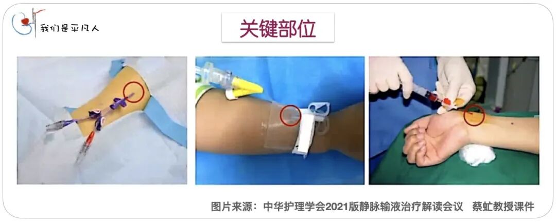 无菌治疗巾是什么透析护理操作中的无菌非接触技术，你get到了吗？_https://www.jmylbn.com_新闻资讯_第7张