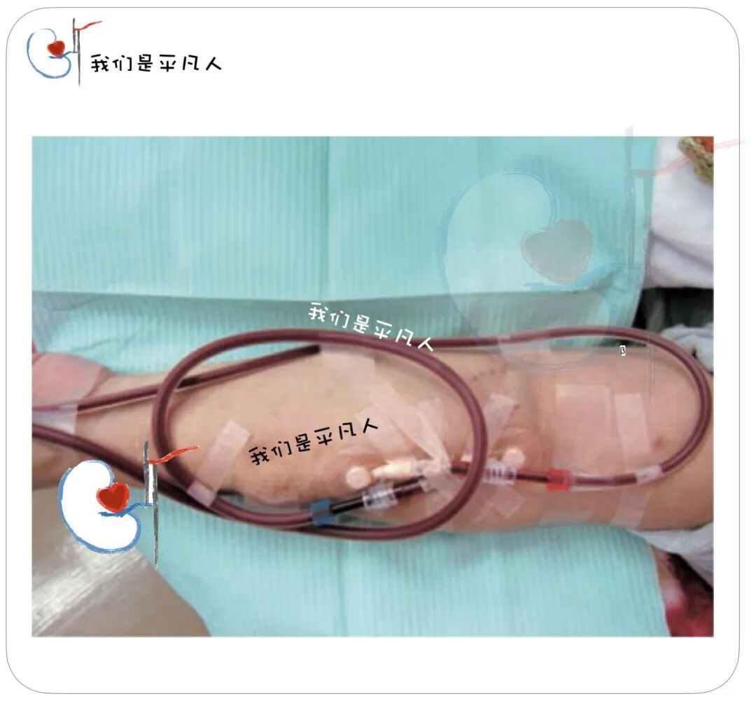 穿刺针怎么用V字固定、α固定、Ω固定，透析管路和穿刺针的固定方法，您用对了吗？_https://www.jmylbn.com_新闻资讯_第9张