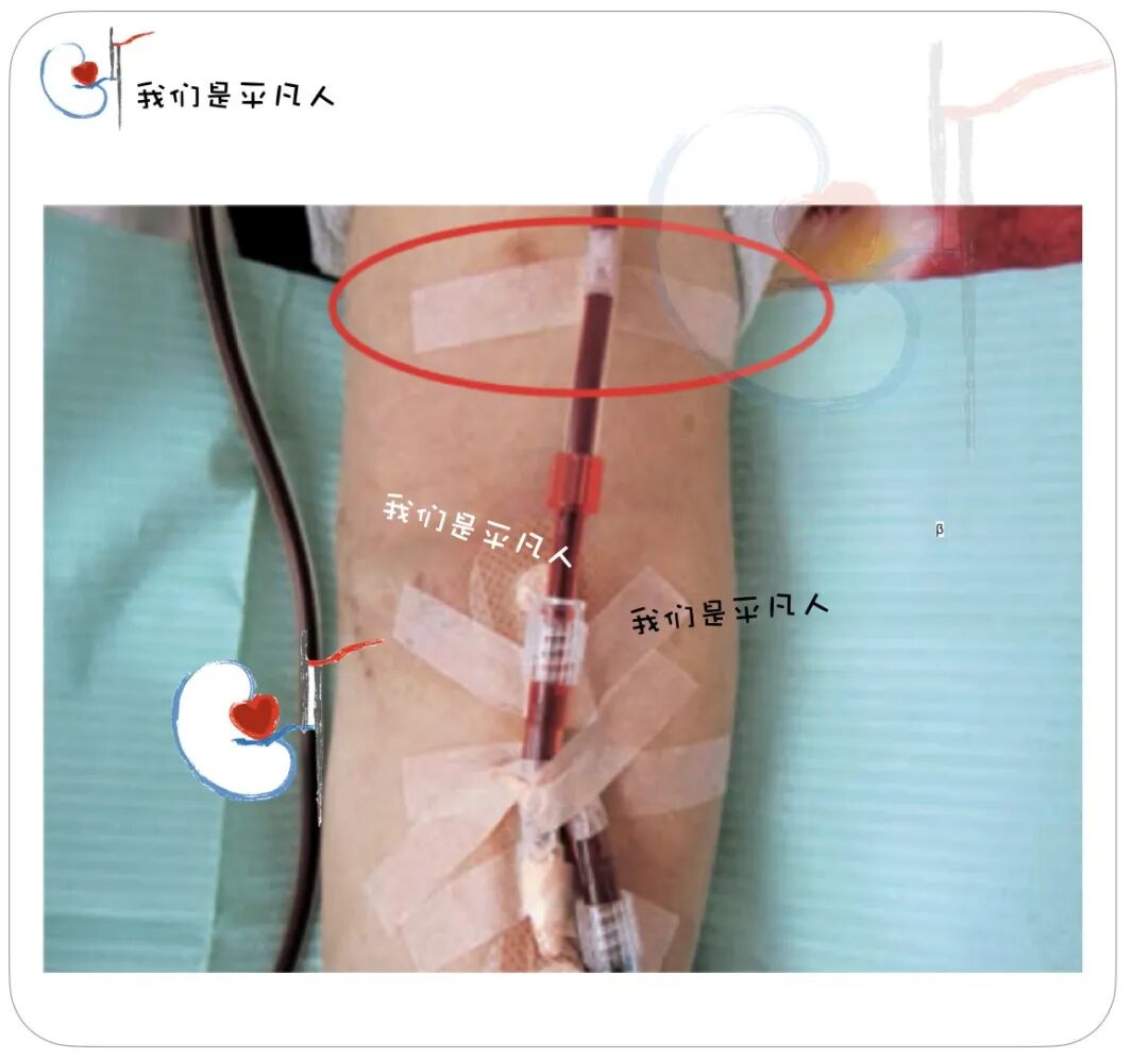 穿刺针怎么用V字固定、α固定、Ω固定，透析管路和穿刺针的固定方法，您用对了吗？_https://www.jmylbn.com_新闻资讯_第8张
