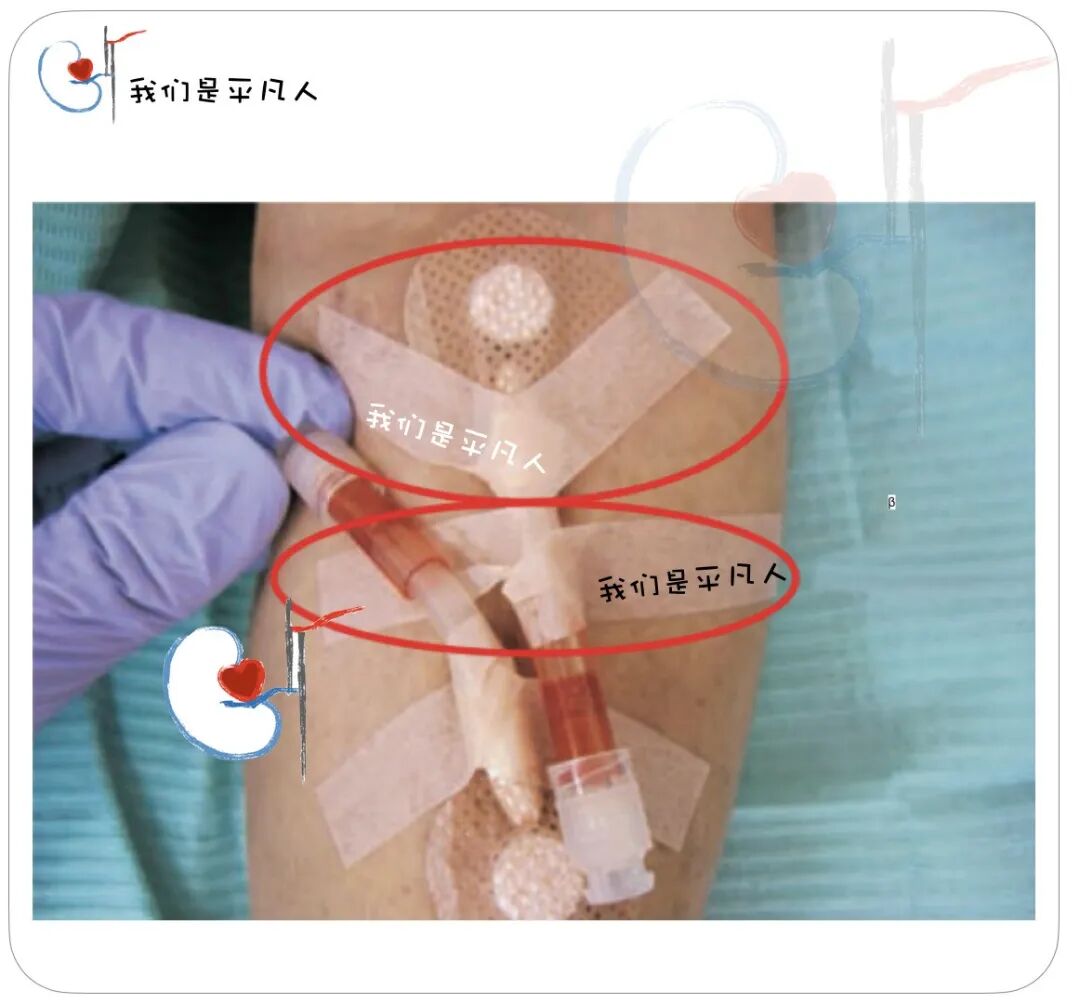 穿刺针怎么用V字固定、α固定、Ω固定，透析管路和穿刺针的固定方法，您用对了吗？_https://www.jmylbn.com_新闻资讯_第7张