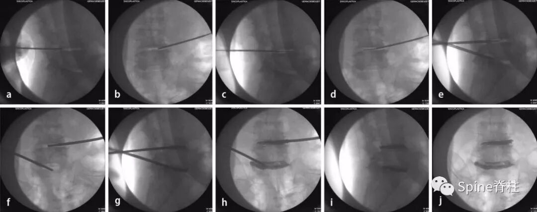 一种创新的骨科技术——经皮骨水泥椎间盘成形术！