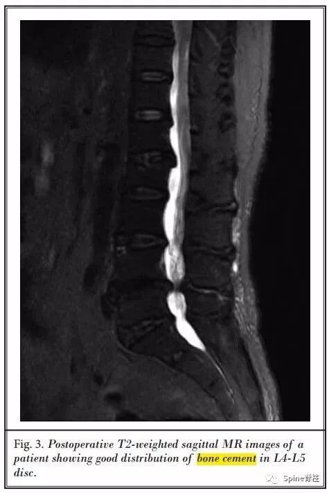 一种创新的骨科技术——经皮骨水泥椎间盘成形术！