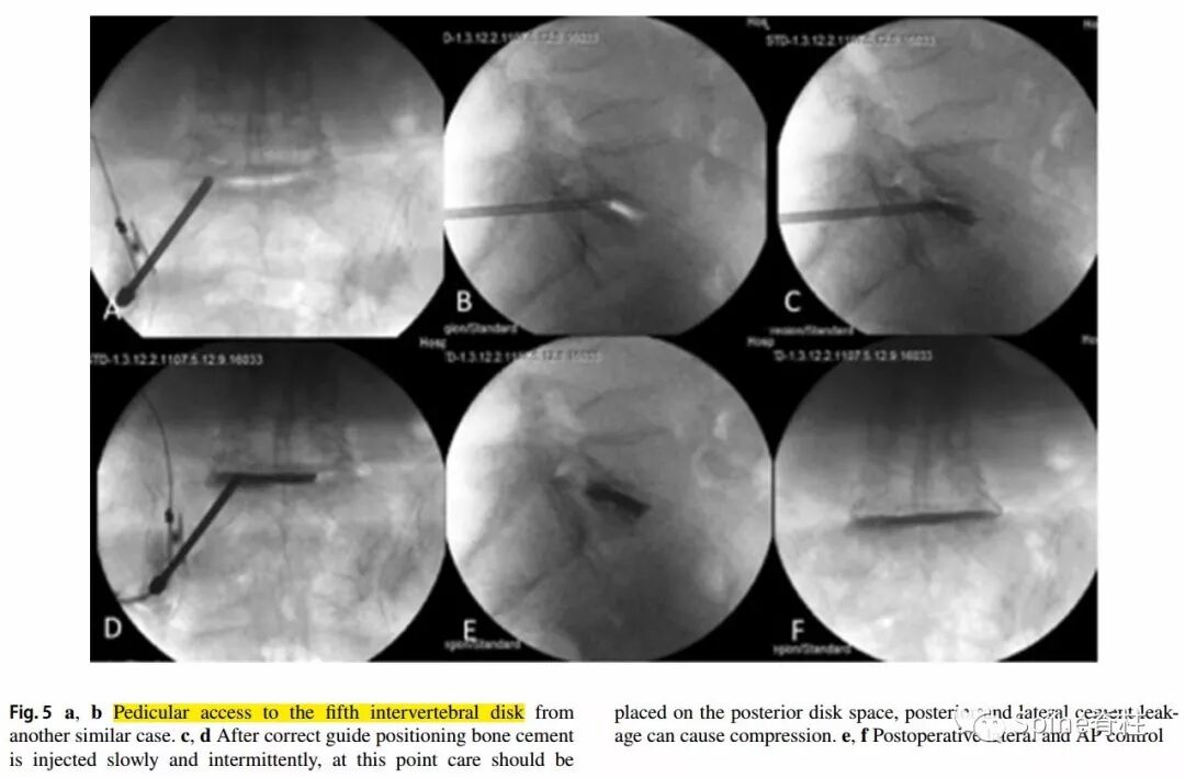 一种创新的骨科技术——经皮骨水泥椎间盘成形术！