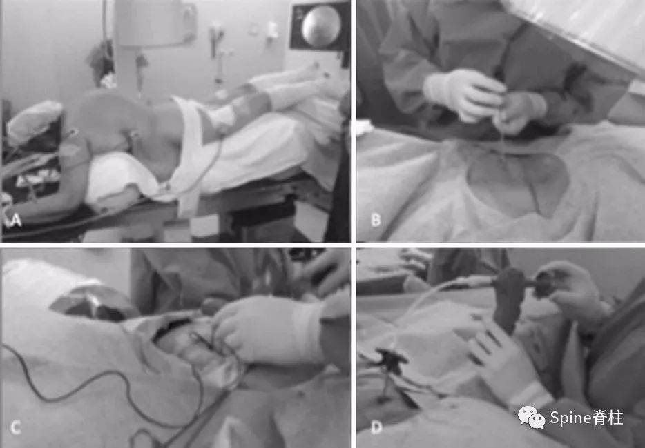 一种创新的骨科技术——经皮骨水泥椎间盘成形术！