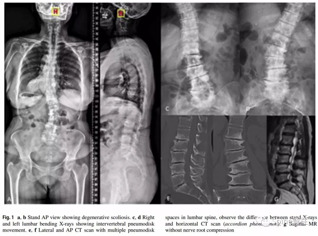 一种创新的骨科技术——经皮骨水泥椎间盘成形术！