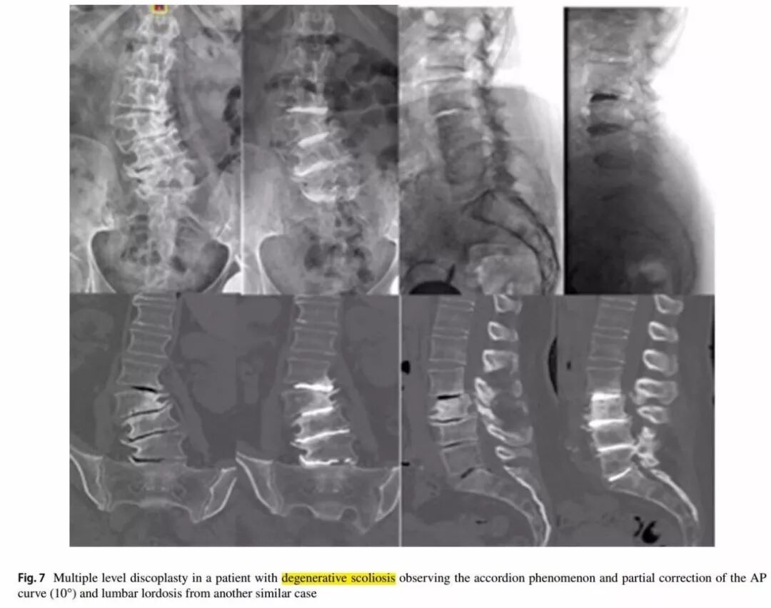 一种创新的骨科技术——经皮骨水泥椎间盘成形术！
