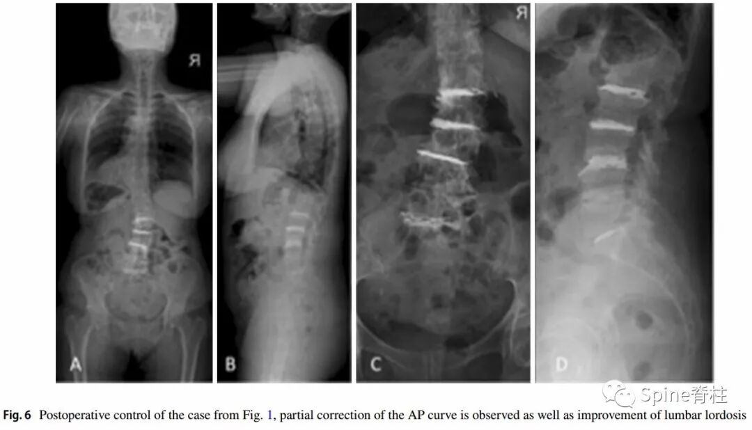 一种创新的骨科技术——经皮骨水泥椎间盘成形术！
