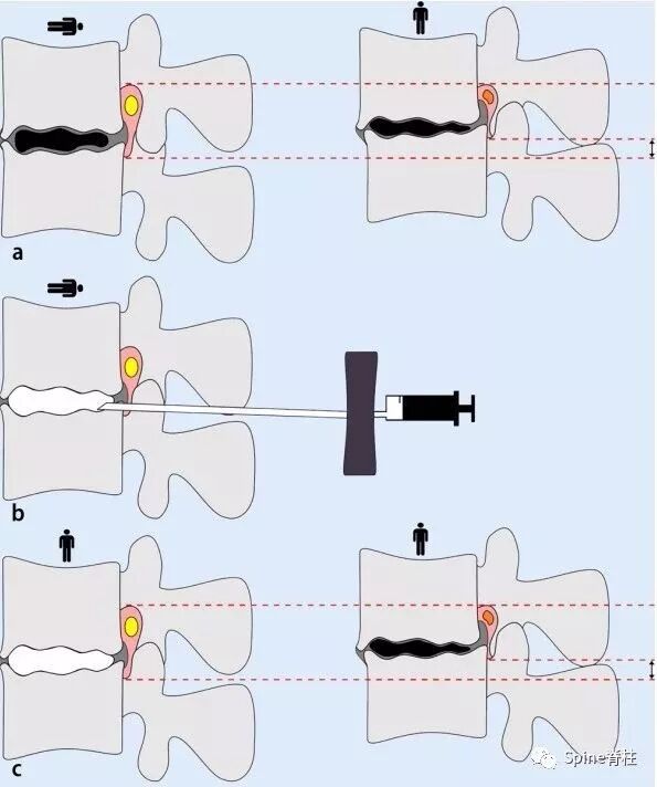 一种创新的骨科技术——经皮骨水泥椎间盘成形术！