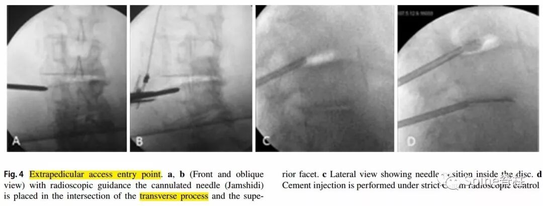 一种创新的骨科技术——经皮骨水泥椎间盘成形术！