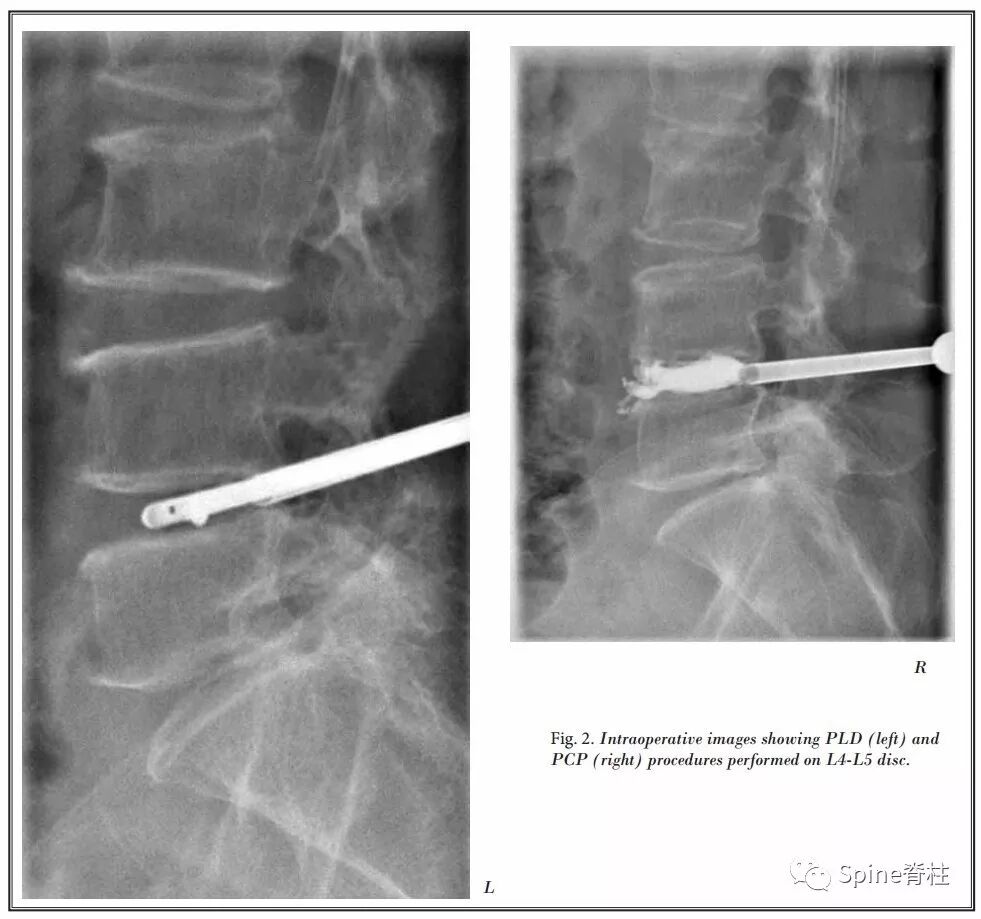 一种创新的骨科技术——经皮骨水泥椎间盘成形术！