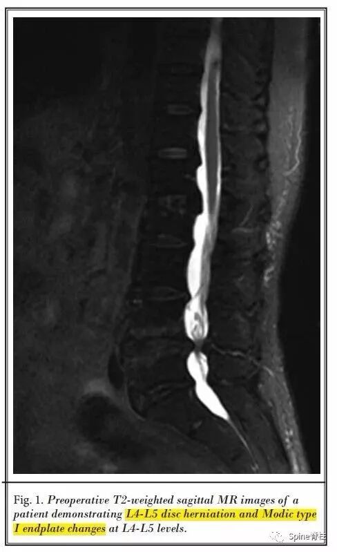 一种创新的骨科技术——经皮骨水泥椎间盘成形术！