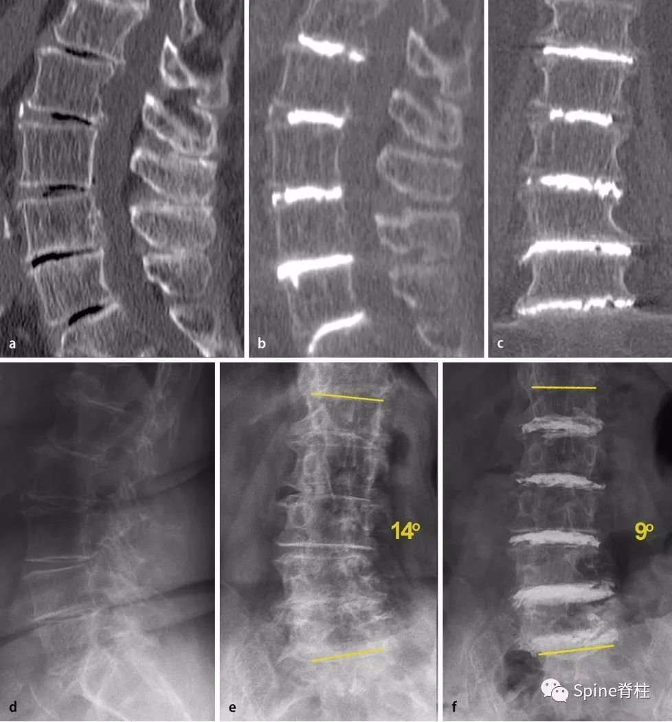 一种创新的骨科技术——经皮骨水泥椎间盘成形术！