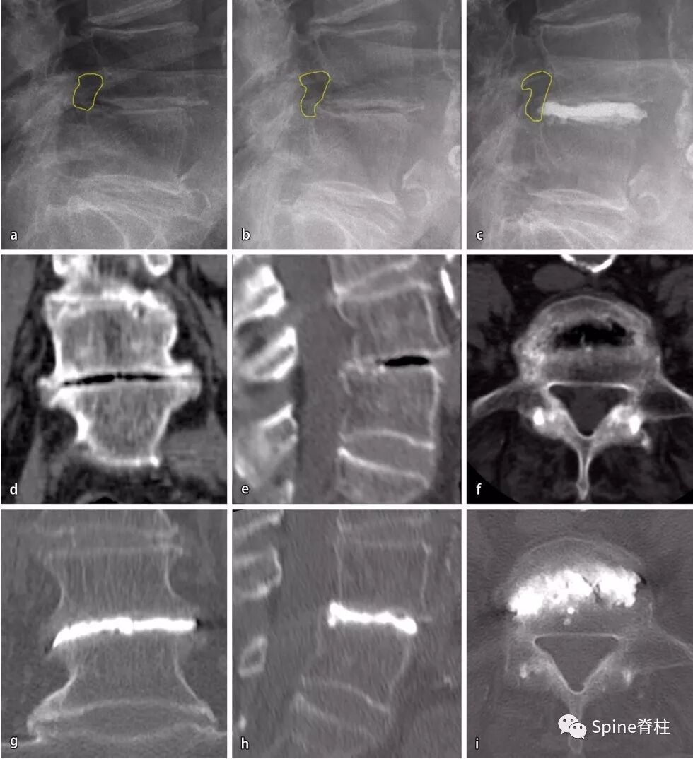 一种创新的骨科技术——经皮骨水泥椎间盘成形术！
