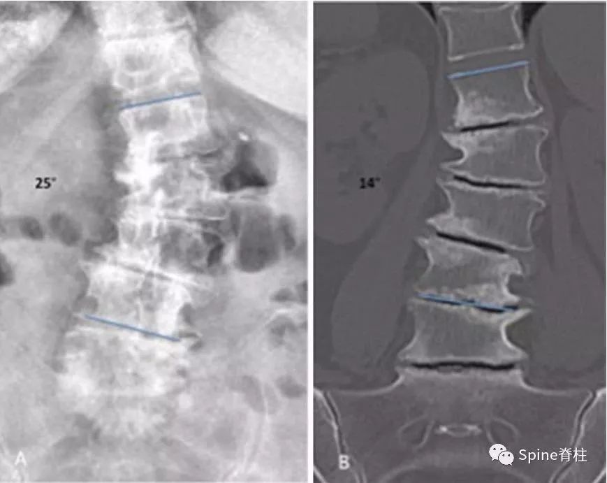 一种创新的骨科技术——经皮骨水泥椎间盘成形术！