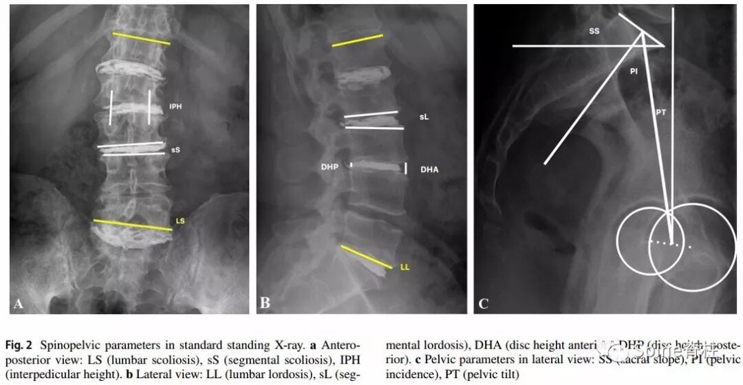 一种创新的骨科技术——经皮骨水泥椎间盘成形术！