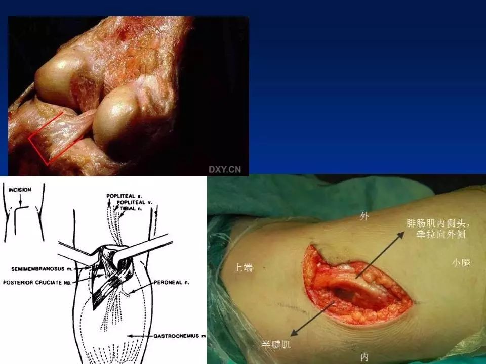 腘窝囊肿切口入路图片