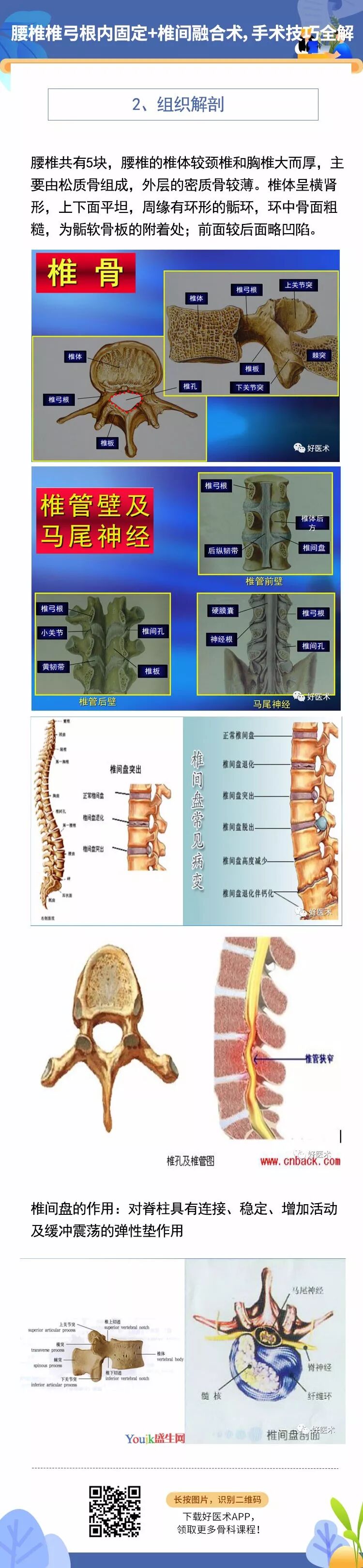 腰椎椎弓根内固定+椎间融合术，手术技巧全解析！