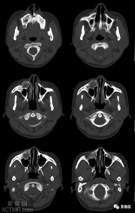 上颌骨ct图片