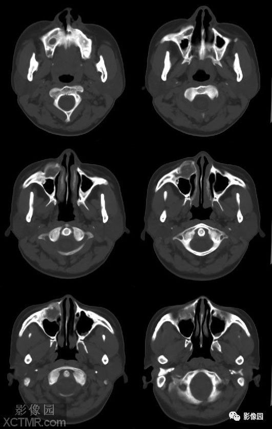 右侧上颌骨骨化性纤维瘤ct病例图片影像诊断分析