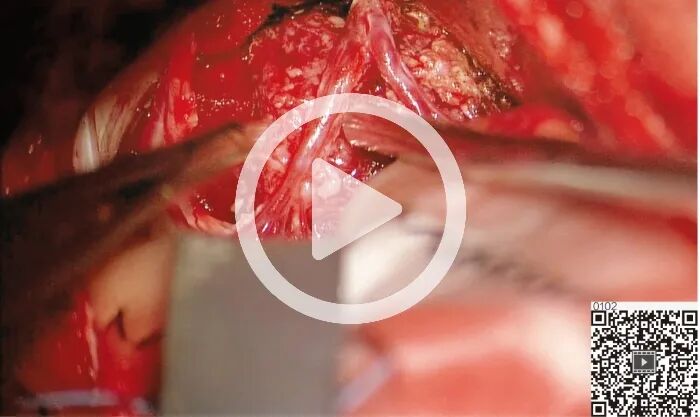 吸引器怎么使用演示视频 ｜ 张俊廷：双极和吸引器的配合使用_https://www.jmylbn.com_新闻资讯_第3张