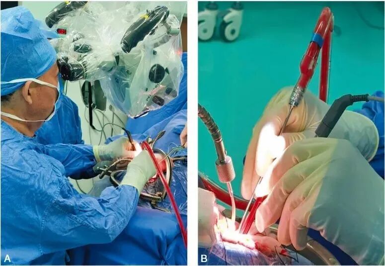 吸引器怎么使用演示视频 ｜ 张俊廷：双极和吸引器的配合使用_https://www.jmylbn.com_新闻资讯_第1张