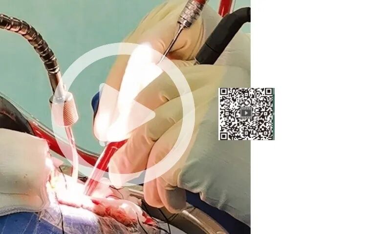 吸引器怎么使用演示视频 ｜ 张俊廷：双极和吸引器的配合使用_https://www.jmylbn.com_新闻资讯_第2张