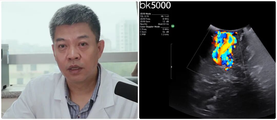 什么是术中探头BK特约 ｜ 专访济南市儿童医院王广宇：小儿神外年手术量500台以上  术中超声+神经导航更加精准微创-上海聚慕医疗器械有限公司